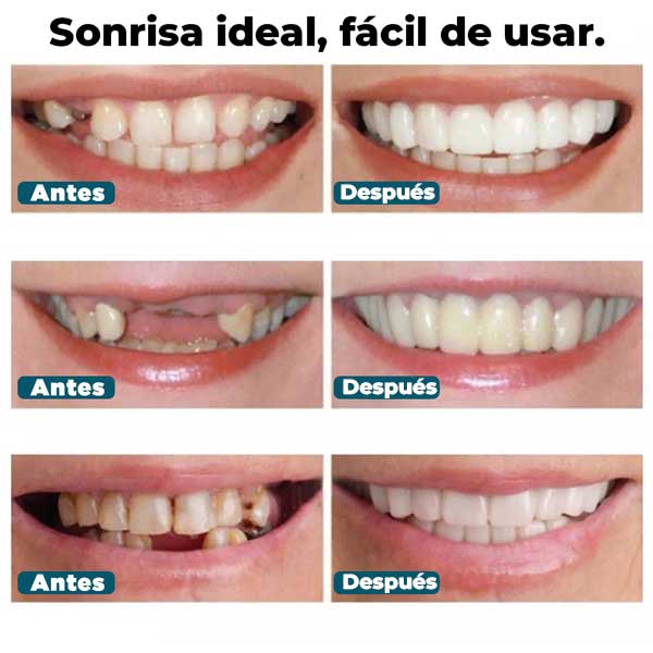 SonrisaPerfecta® - Carillas Dentales Naturales Removibles