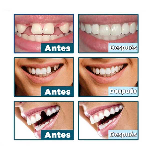 SonrisaPerfecta® - Carillas Dentales Naturales Removibles